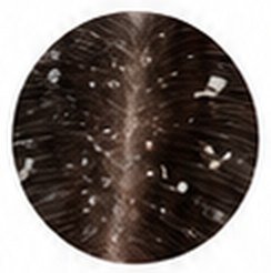 Close-up of scalp with dandruff flakes